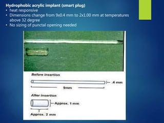 Hydrophobic acrylic implant (smart plug)
• heat responsive
• Dimensions change from 9x0.4 mm to 2x1.00 mm at temperatures
above 32 degree
• No sizing of punctal opening needed
 