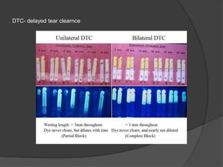 DTC- delayed tear clearnce
 