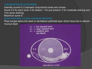 VAN BIIJSTERVELD SCORING
Intensity scored in 2 exposed conjunctival zones and cornea
Score 0-3 for each zone. 0 for absent, 1 for just present, 2 for moderate staining and
3 for gross staining.
Maximum score 9.
Score more than 3.5 was considered abnormal.
Rose bengal stains the dead or devitalized epithelial layer which have lost or altered
mucous layer.
 