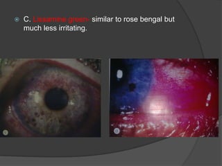  C. Lissamine green- similar to rose bengal but
much less irritating.
 
