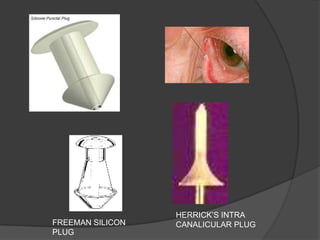 FREEMAN SILICON
PLUG
HERRICK‟S INTRA
CANALICULAR PLUG
 