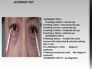 SCHIRMER TEST 
SCHIRMER'S TEST I 
If wetting >10mm = normal eye 
If wetting <3mm = very severe dry eye 
If wetting 3-5 mm = severe dry eye 
If wetting 5-10mm = moderate dry eye 
If wetting is 10mm = mild dry eye 
SCHIRMER'S TEST II 
If Wetting<10mm -- >irratate the nasal 
mucosa with cotton bud & note the wetting 
after 2 min. 
If no Wetting or <1mm Sjogren's 
syndrome 
If Wetting increases by 1mm Non-Sjogren's 
syndrome 
SCHIRMER'S TEST III – no diagnostic 
 