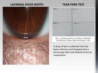 LACRIMAL RIVER WIDTH TEAR FERN TEST 
A drop of tear is collected from the 
lower meniscus and dropped onto a 
microscope slide and allowed to dry by 
evaporation. 
 