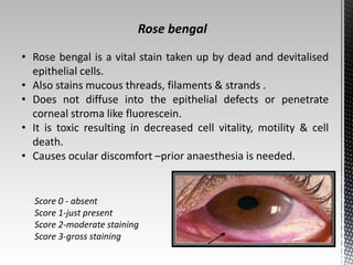 Rose bengal 
• Rose bengal is a vital stain taken up by dead and devitalised 
epithelial cells. 
• Also stains mucous threads, filaments & strands . 
• Does not diffuse into the epithelial defects or penetrate 
corneal stroma like fluorescein. 
• It is toxic resulting in decreased cell vitality, motility & cell 
death. 
• Causes ocular discomfort –prior anaesthesia is needed. 
Score 0 - absent 
Score 1-just present 
Score 2-moderate staining 
Score 3-gross staining 
 