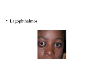 • Lagophthalmos
 
