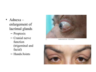 • Adnexa –
enlargement of
lacrimal glands
– Proptosis
– Cranial nerve
function
(trigeminal and
facial)
– Hands/Joints
 