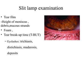 Slit lamp examination
• Tear film
-Height of meniscus ,
debris,mucous strands
• Foam ,
• Tear break-up time (T-BUT)
– Eyelashes: trichiasis,
distichiasis, madarosis,
deposits
 