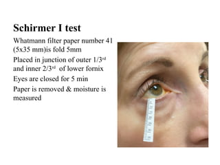 Schirmer I test
Whatmann filter paper number 41
(5х35 mm)is fold 5mm
Placed in junction of outer 1/3rd
and inner 2/3rd
of lower fornix
Eyes are closed for 5 min
Paper is removed & moisture is
measured
 