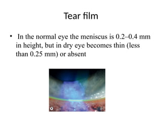 Tear film
• In the normal eye the meniscus is 0.2–0.4 mm
in height, but in dry eye becomes thin (less
than 0.25 mm) or absent
 