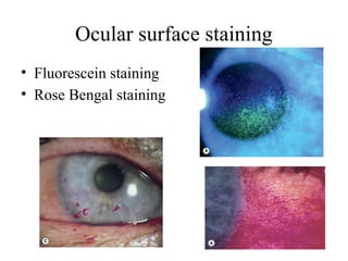 Ocular surface staining
• Fluorescein staining
• Rose Bengal staining
 