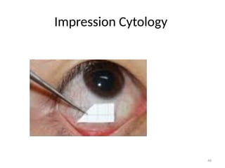 46
Impression Cytology
 