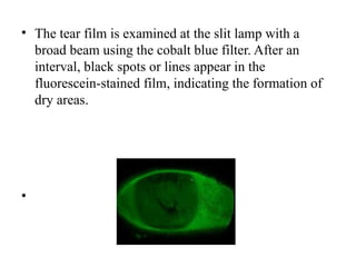 • The tear film is examined at the slit lamp with a
broad beam using the cobalt blue filter. After an
interval, black spots or lines appear in the
fluorescein-stained film, indicating the formation of
dry areas.
•
 