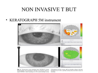 NON INVASIVE T BUT
• KERATOGRAPH 5M instrument
 