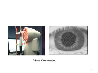 53
Video Keratoscope
 