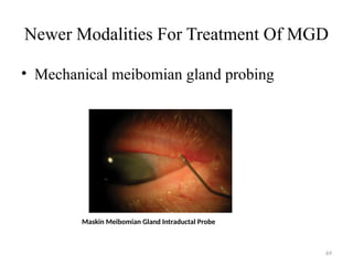 69
Newer Modalities For Treatment Of MGD
• Mechanical meibomian gland probing
Maskin Meibomian Gland Intraductal Probe
 