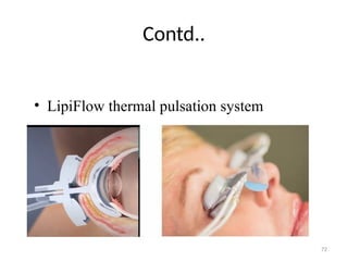 72
Contd..
• LipiFlow thermal pulsation system
 