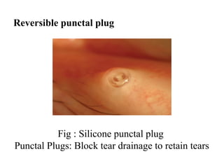 Fig : Silicone punctal plug
Punctal Plugs: Block tear drainage to retain tears
Reversible punctal plug
 