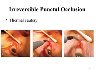78
Irreversible Punctal Occlusion
• Thermal cautery
 