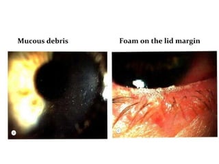 Mucous debris Foam on the lid margin
 