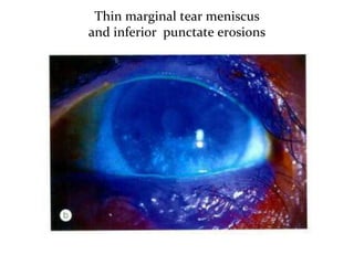 Thin marginal tear meniscus
and inferior punctate erosions
 