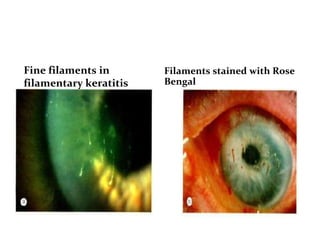 Fine filaments in
filamentary keratitis
Filaments stained with Rose
Bengal
 