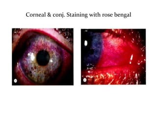 Corneal & conj. Staining with rose bengal
 
