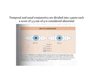 Temporal and nasal conjunctiva are divided into 3 parts each
a score of 3.5 out of 9 is considered abnormal
 