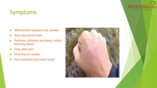 Symptoms
 Affected skin appears dull, peeled.
 Itchy and painful skin.
 Redness, itchiness and deep cracks
that may bleed.
 Gray ashy skin.
 Fine lines or cracks.
 Skin that feels and looks rough.
 