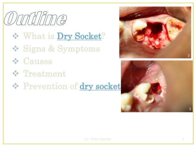 Dry Socket