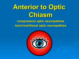 Anterior to Optic
        Chiasm
    -     compressive optic neuropathies
-       toxic/nutritional optic neuropathies
 