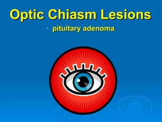 Optic Chiasm Lesions
     -   pituitary adenoma
 