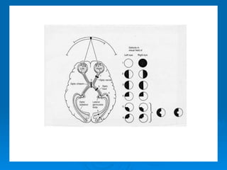 Visual Field Defects
 
