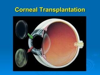 Corneal Transplantation
 