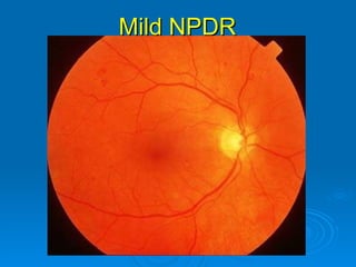 Mild NPDR
 