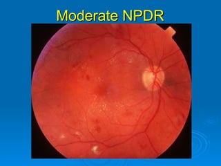 Moderate NPDR
 