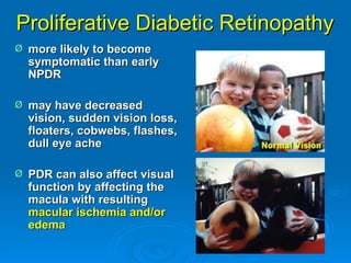 Proliferative Diabetic Retinopathy
Ø   more likely to become
    symptomatic than early
    NPDR

Ø   may have decreased
    vision, sudden vision loss,
    floaters, cobwebs, flashes,
    dull eye ache

Ø   PDR can also affect visual
    function by affecting the
    macula with resulting
    macular ischemia and/or
    edema
 