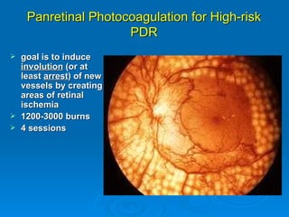 Panretinal Photocoagulation for High-risk
                     PDR
 goal is to induce
  involution (or at
  least arrest) of new
  vessels by creating
  areas of retinal
  ischemia
 1200-3000 burns
 4 sessions
 