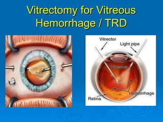 Vitrectomy for Vitreous
  Hemorrhage / TRD
 