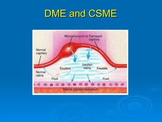 DME and CSME
 