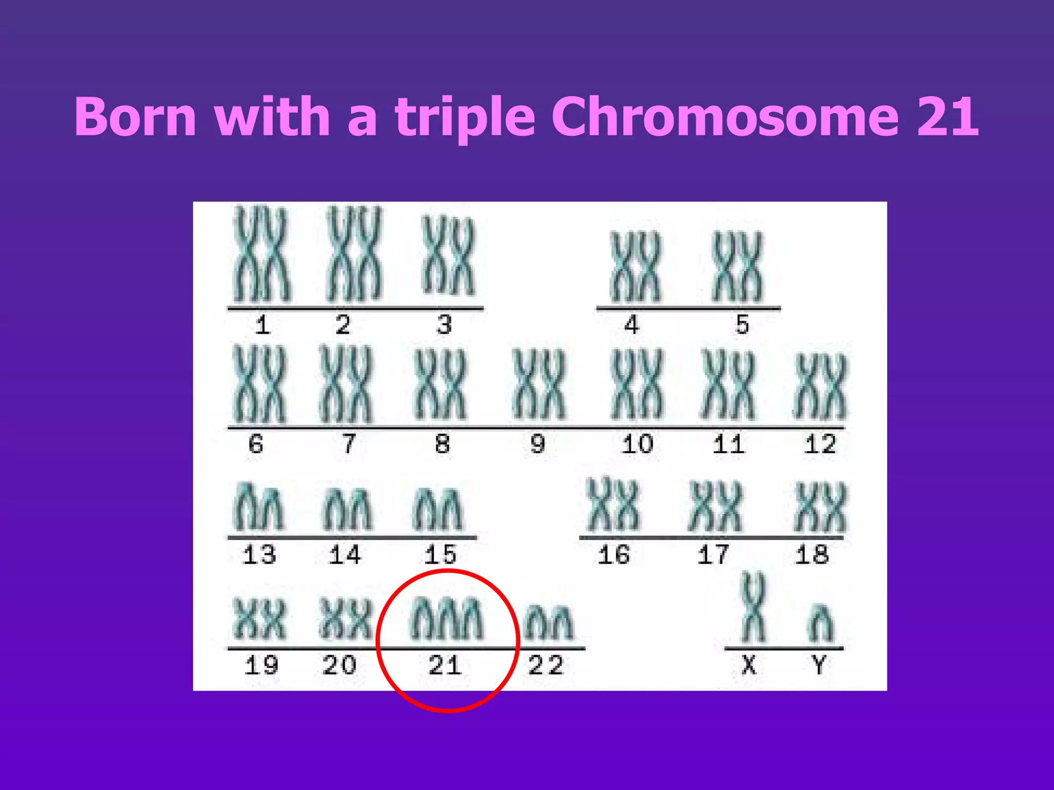 Born with a triple Chromosome 21 