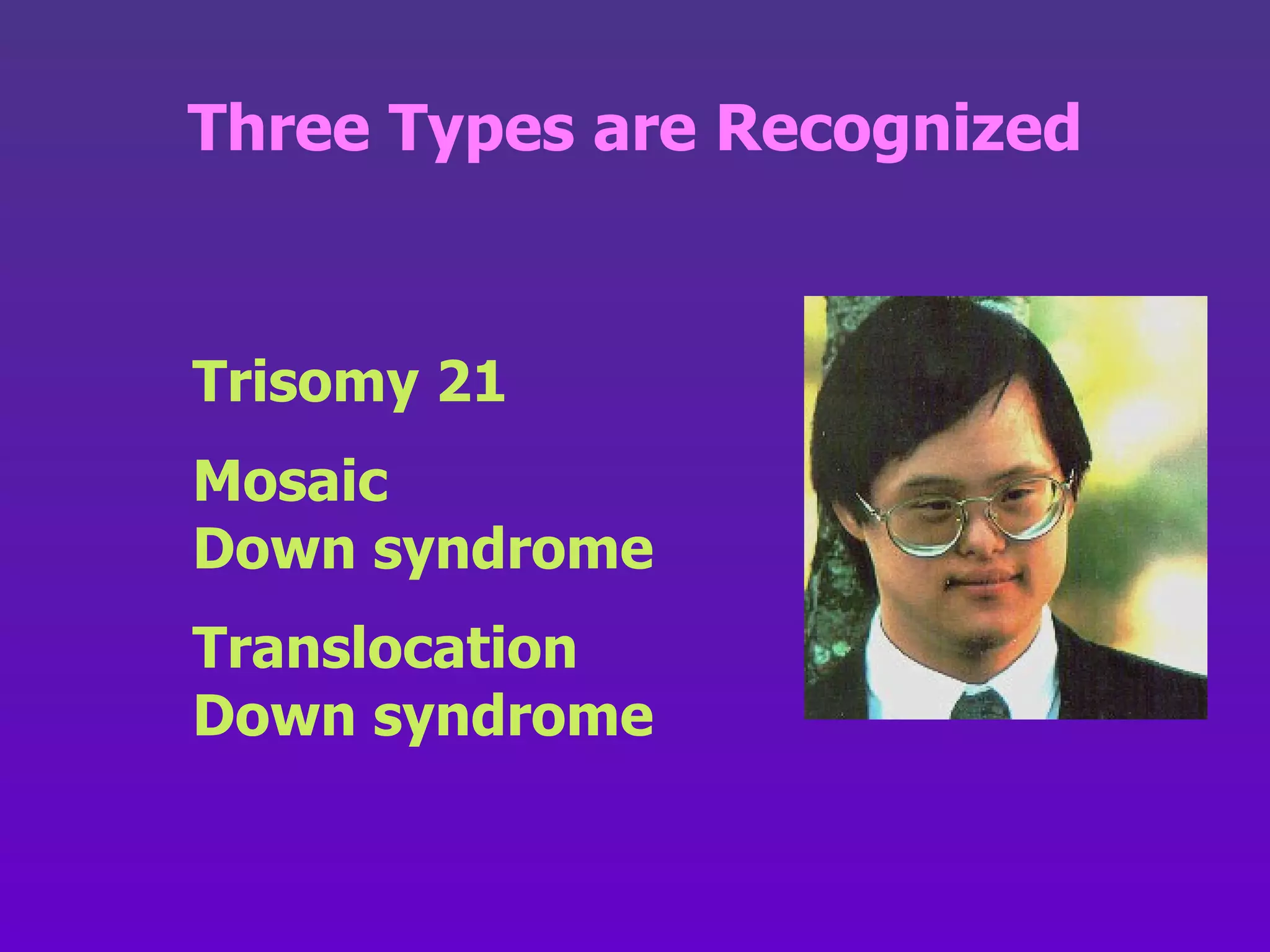 Trisomy 21 Mosaic  Down syndrome Translocation  Down syndrome Three Types are Recognized 