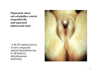 Pigmented, short,
curved phallus, central
urogenital slit,
and separated
labioscrotal testis
A 46,XY patient known
to have congenital
adrenal hyperplasia due
to 3β-hydroxy
dehydrogenase
deficiency
26
 