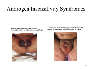 Androgen Insensitivity Syndromes
Partial androgen insensitivity with
descended testes in bifid labioscrotal folds
Less severe partial androgen insensitivity with
severe hypospadias and maldescent of testes
27
 