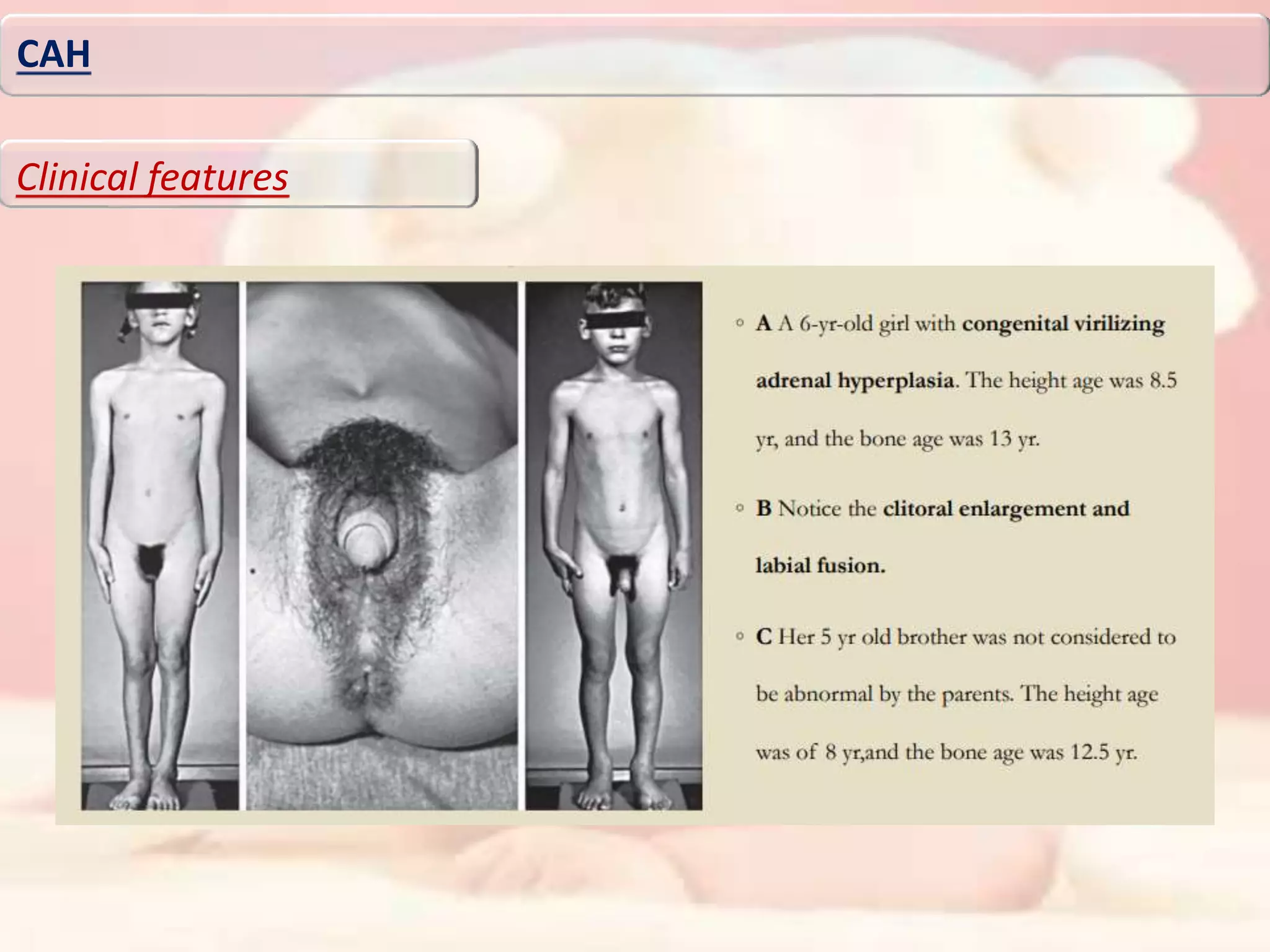 CAH
Clinical features
 