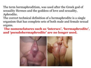 The term hermaphroditism, was used after the Greek god of
sexuality Hermes and the goddess of love and sexuality,
Aphrodite.
The correct technical definition of a hermaphrodite is a single
organism that has complete sets of both male and female sexual
organs.
The nomenclatures such as ‘intersex’, ‘hermaphrodite’,
and ‘pseudohermaphrodite’ are no longer used.
 