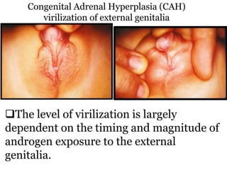 Congenital Adrenal Hyperplasia (CAH)
virilization of external genitalia
The level of virilization is largely
dependent on the timing and magnitude of
androgen exposure to the external
genitalia.
 