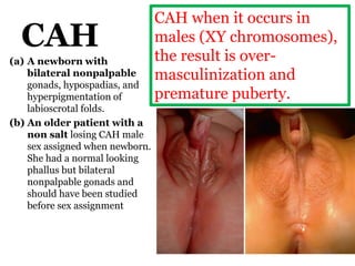 CAH
(a) A newborn with
bilateral nonpalpable
gonads, hypospadias, and
hyperpigmentation of
labioscrotal folds.
(b) An older patient with a
non salt losing CAH male
sex assigned when newborn.
She had a normal looking
phallus but bilateral
nonpalpable gonads and
should have been studied
before sex assignment
CAH when it occurs in
males (XY chromosomes),
the result is over-
masculinization and
premature puberty.
 