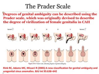 The Prader Scale
Degrees of genital ambiguity can be described using the
Prader scale, which was originally devised to describe
the degree of virilization of female genitalia in CAH
Rink RC, Adams MC, Misseri R (2005) A new classification for genital ambiguity and
urogenital sinus anomalies. BJU Int 95:638–642
 