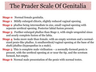 The Prader Scale Of Genitalia
Stage 0 Normal female genitalia.
Stage 1 Mildly enlarged clitoris, slightly reduced vaginal opening.
Stage 2 phallus being intermediate in size, small vaginal opening with
separate urethral opening. Posterior labial fusion present.
Stage 3 Further enlarged phallus than Stage 2, with single urogenital sinus
and nearly complete fusion of the labia.
Stage 4 looks more male than female, with an empty scrotum and a normal-
sized penis-like phallus. A smallurethral/vaginal opening at the base of the
shaft/phallus (hypospadias in a male).
Stage 5 This is complete male virilisation – a normally-formed penis is
present, with the urethral opening at or near the tip, and the scrotum
formed, but empty.
Stage 6 Normal male presentation of the penis with normal testes.
 