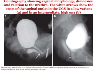 Genitography showing vaginal morphology, dimension
and relation to the urethra. The white arrows show the
onset of the vaginal outlet in the UGS in a low variant
(a) and in an intermediate, high one (b)
Genitography is performed by occluding the perineal orifice with a balloon catheter. Contrast material is injected in a
retrograde fashion, with lateral and oblique views obtained.
 